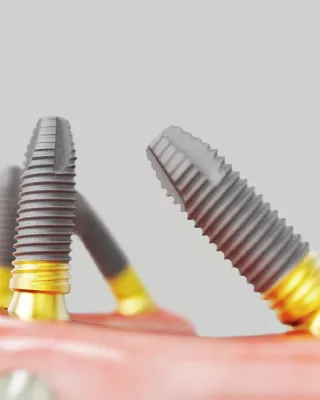 Nobel Biocare All-on-4 Treatment Concept