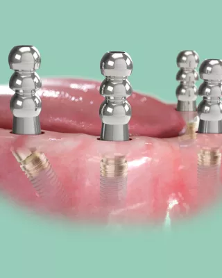 A new addition to the X-Guide digital workflow designed for full-arch cases. With FastMap, you can accurately map the final implant position and automatically register your 3D plan with the corresponding anatomy – all directly within X-Guide.
