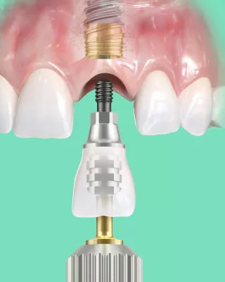 Nobel Biocare immediate implant placement