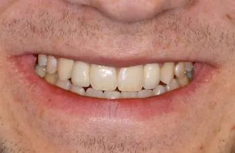 View of patient when smiling. The implant-supported crown at the right lateral incisor blends harmoniously with the rest of the dentition.