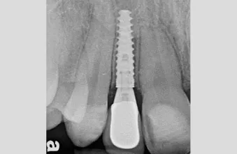 Periapical radiograph: Limited bone between the implant and the adjacent teeth suggests that the 3.0 mm tapered implant was ideal for this site