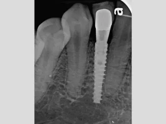 Pretreatment periapical radiograph suggests extensive decay has occurred. There is limited space for a dental implant, dictating the use of the 3.0 mm NobelActive.