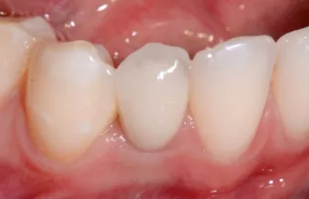 Close-up clinical view of the cemented final crown at six months post-insertion (Prosthetic care provided by Howard Rosen-thal, DDS, Newtown, PA, USA.