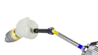 Angulated screw channel