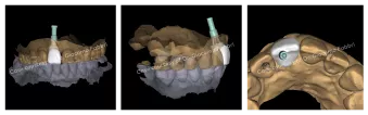 Case courtesy of Dr. Giacomo Fabbri