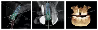 Case courtesy of Dr. Giacomo Fabbri