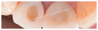 Case courtesy of Dr. Giacomo Fabbri