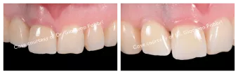 Case courtesy of Dr. Giacomo Fabbri