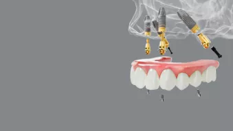 Nobel Biocare all-on-4