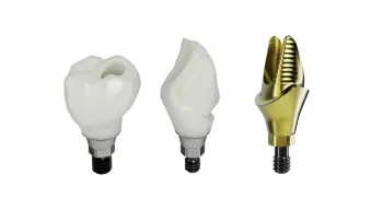 Customized abutments & implant crowns
