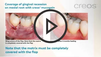 Coverage of gingival recession on mesial root with creos mucogain