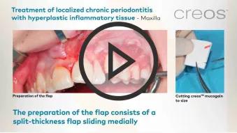 Treatment of localized chronic periodontitis with hyperplastic inflammatory tissue