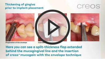 Thickening of gingiva prior to implant placement video