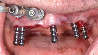 Fastmap clinical case, courtesy of Dr. Pitino