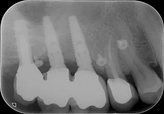 Figure 10: Post-operative radiograph
