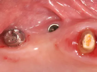 Figure 2: Buccal view of the ailing implant showing the high frenum attachment, the misplaced implant, and the poor quality of the mucosa.