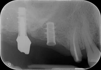 Figure 3: Pre-operative peri-apical radiograph showing the ailing implant.