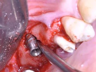 Implant removal.