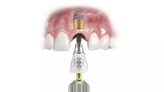 Immediate solutions product close-up