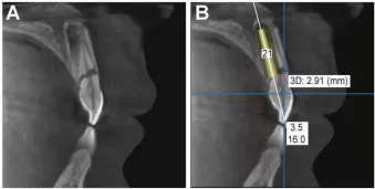 CBCT scan is made for diagnosis (Fig. 2A) and planning (Fig. 2B)