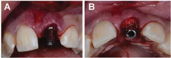 A temporary abutment is placed onto the NobelActive implant