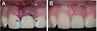 Direct post-operative image of the temporary crown.