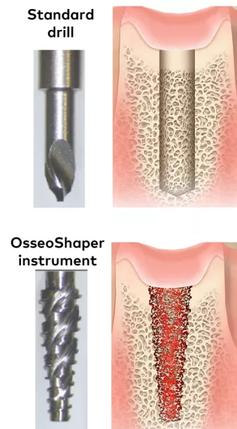 The standard drill protocol creates a smooth osteotomy (top) devoid of osseous coagulum, whereas the OsseoShaper concept (bottom) creates a textured osteotomy
