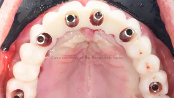X-Act clinical case, courtesy of Dr. Noharet
