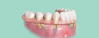 Nobel Biocare All-on-4