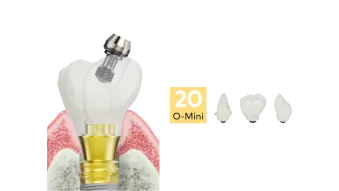 NobelProcera Zirconia crowns