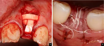 Ridge dimensions close-up Dr. Mark Hagan case