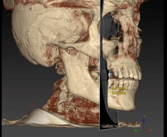 Top tips for re-treatment of dental implant failures: