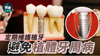 牙齒健康｜定期維護植牙 避免植體牙周病