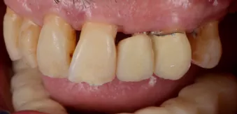 Nobel Biocare N1™ implant system Fixed full-arch implant-supported  rehabilitation following an  immediate implant placement  and provisionalization protocol