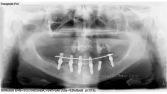 Case courtesy of Dr. Davó