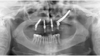 Case courtesy of Prof. Enrico Agliardi