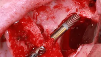 Case courtesy of Dr. Raphael Bonnet