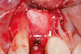 Figure 1b. A 3.0 mm x 13mm NobelActive implant has been placed along with a cover screw.