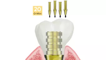 N1 Temporary Abutment