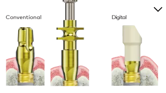Impression taking - N1 implant level restoration
