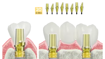 N1 esthetic abutments