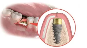 Latest tips and tricks for bone and soft tissue regeneration