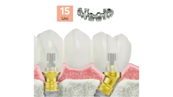 NobelProcera® Titanium implant bridge Framework