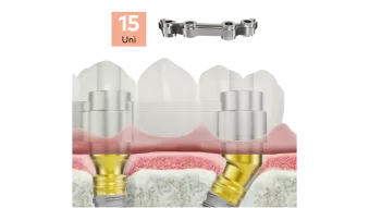 NobelProcera Titanium fixed implant bars
