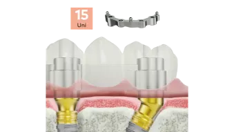NobelProcera Titanium fixed-removable implant bars