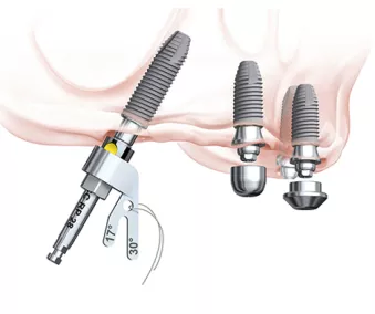 Multi-unit Aligning Instrument