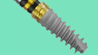 N1 implant placement