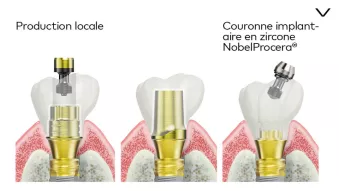 Prothèses d’usage