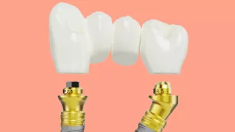 N1 Multi-unit Abutment level