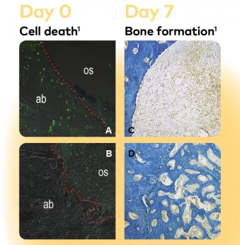 OsseoShaper bone results